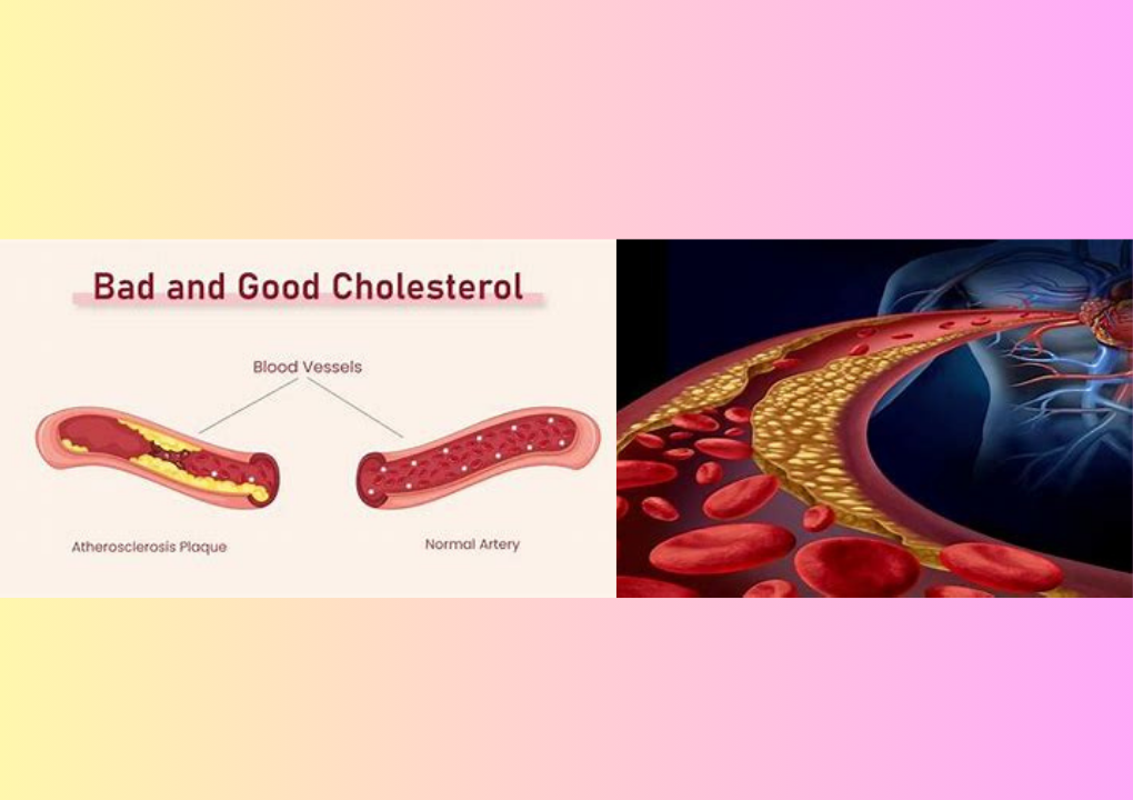 Cholesterol